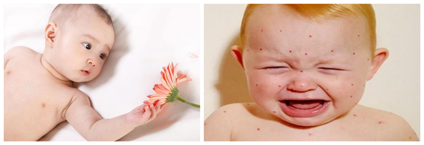 兒童濕疹反反復復，您有在家安裝家用除濕產品嗎？